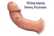 Νόσος του Peyronie (Ινώδης σκλήρυνση του πέους)