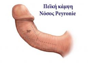 Peyronie's disease (Fibrous hardening of the penis)